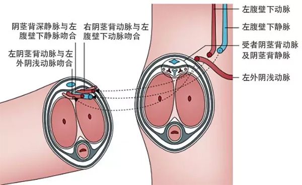 《柳葉刀》報告：三年前接受下體移植的男性已恢復正常功能  