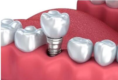 國(guó)家醫(yī)保局：暫未考慮將種植牙納入醫(yī)保